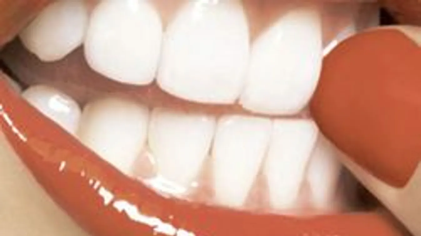 Óvatosan az otthoni fogfehérítéssel! Mutatjuk, mit ronthatsz el!