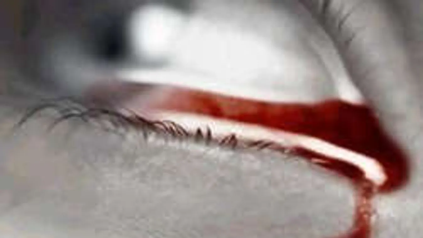 Rejtélyes betegség: vért könnyezik a 18 éves tinilány