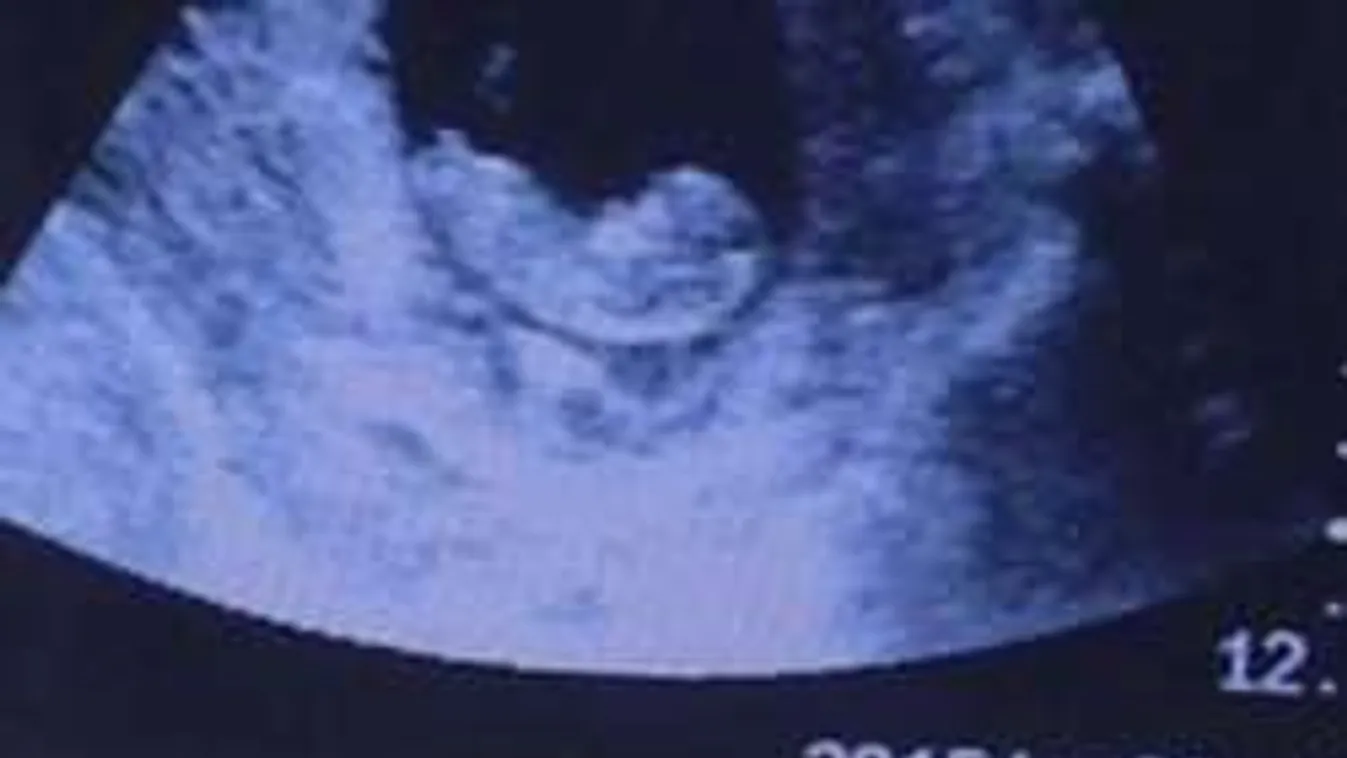 Sokkoló fotó: démoni lény néz ránk a terhességi ultrahangról!