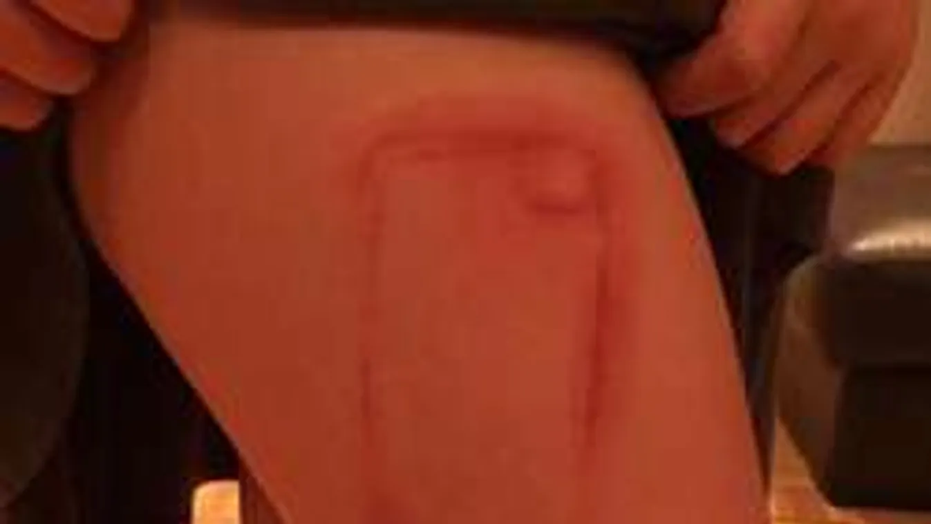 Beleégett a savas telefontok egy 9 éves kislány bőrébe