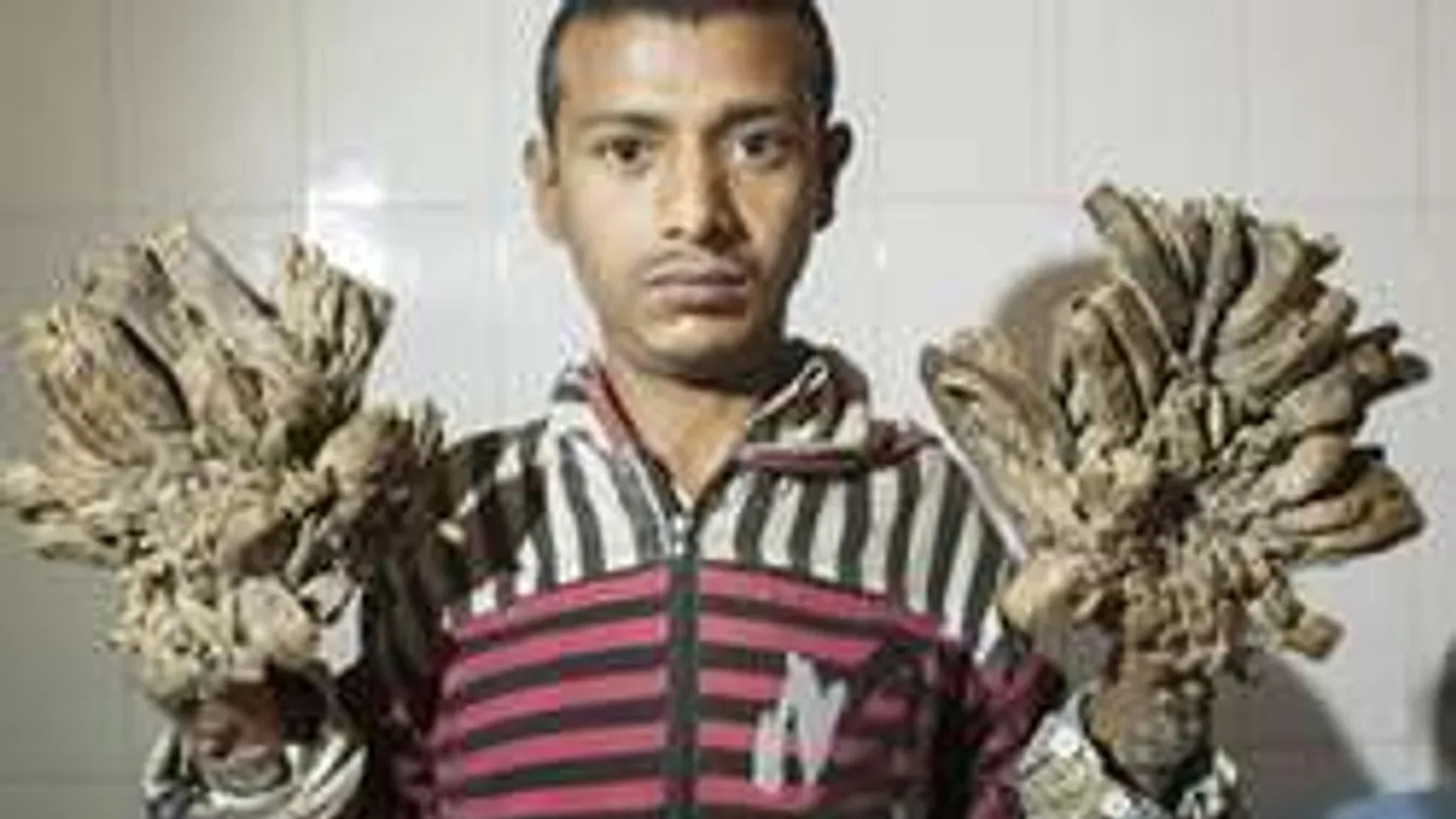 Egy ritka bőrbaj miatt ez a fiatal férfi lassan fává változik: Fotók!