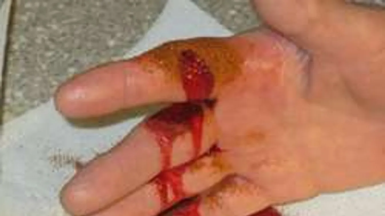 Ezzel a praktikával tíz másodperc alatt el tudod állítani a vérzést