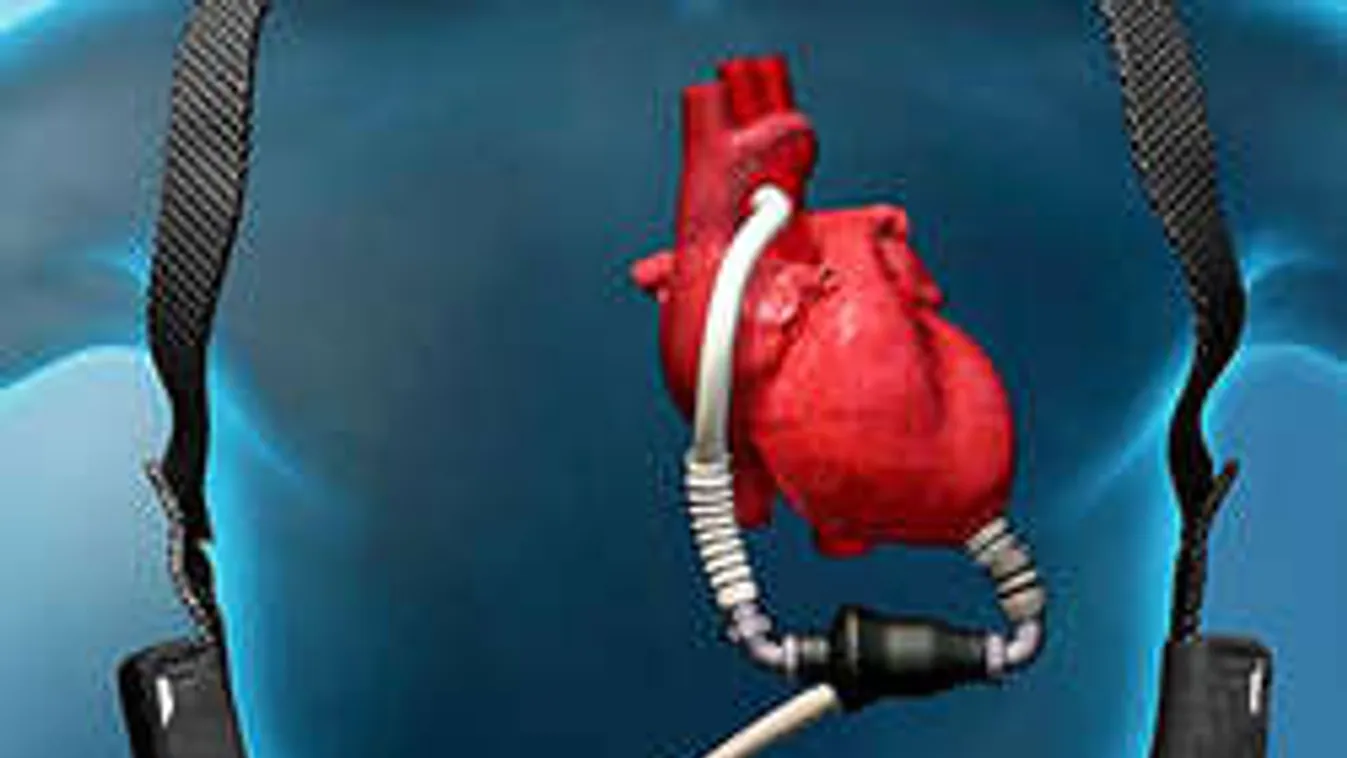 Műszíve van, mégsem jogosult a rokkantkártyára a szegedi férfi!