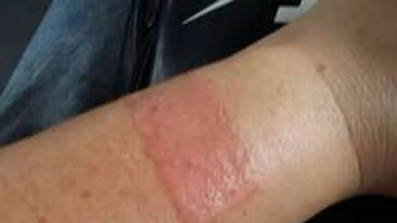 Brutális allergiát okoz a fesztivál karszalagja