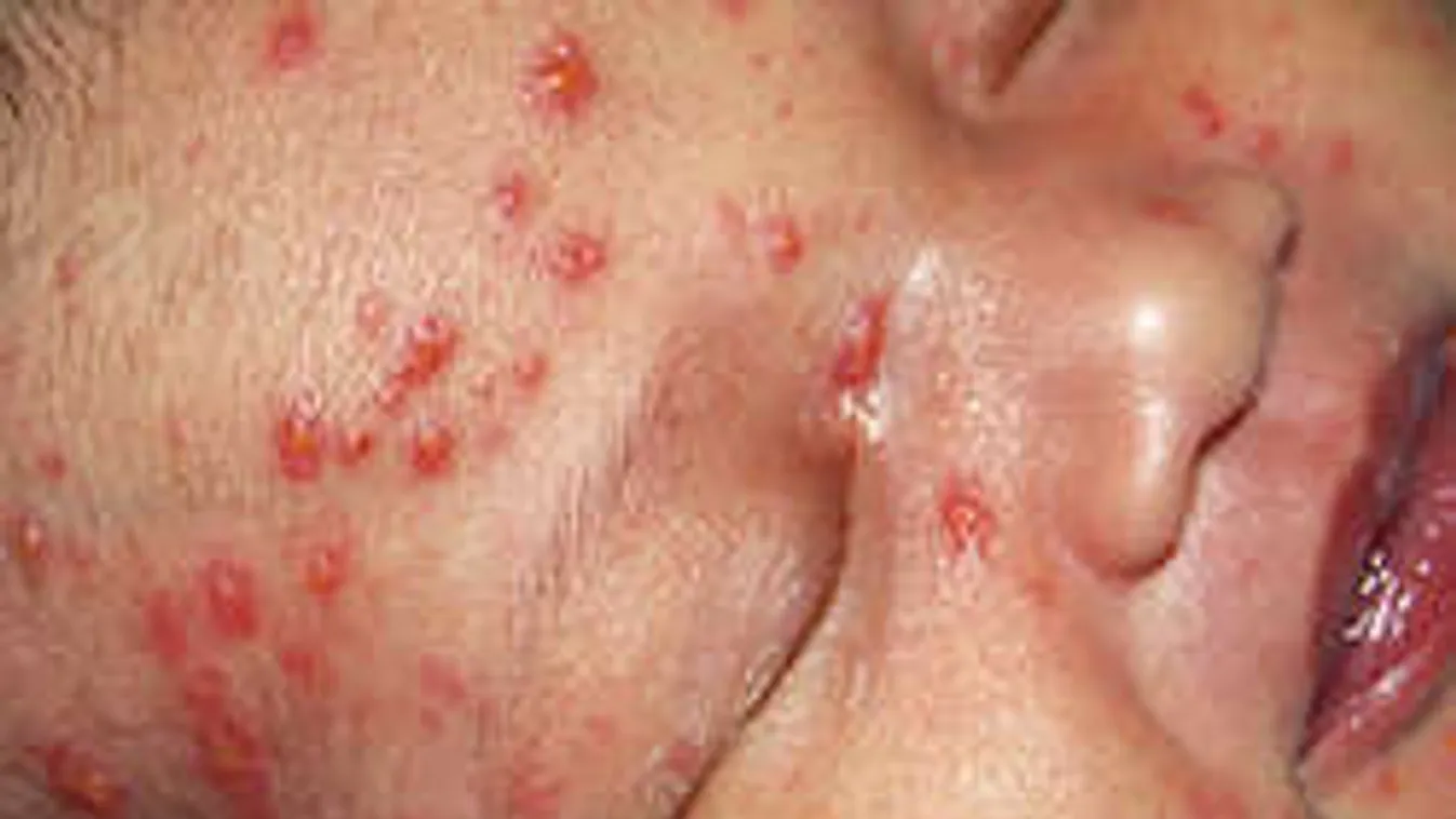 Húsevő baktérium lett a bárányhimlőből