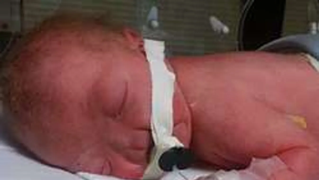 Imádja az internet az orr nélkül született kisfiút!