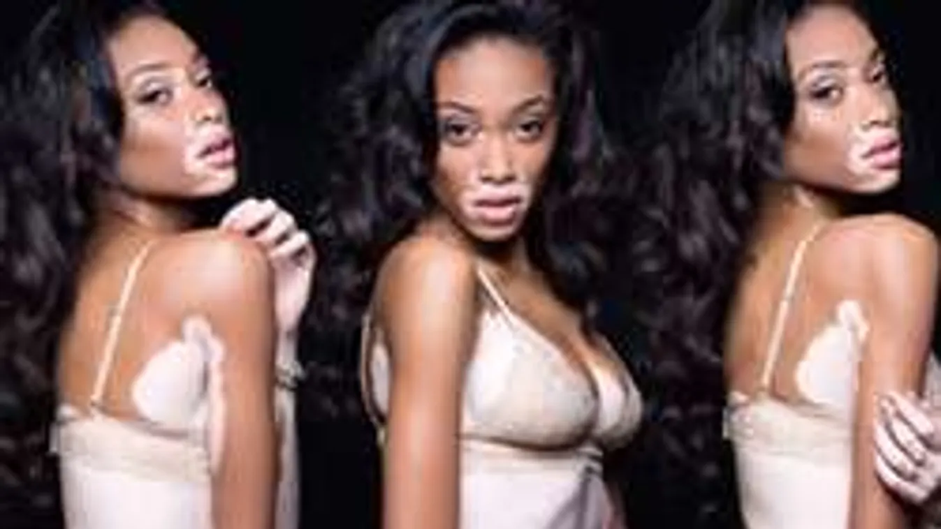 Pigmenthiányos modellel kavar Hamilton