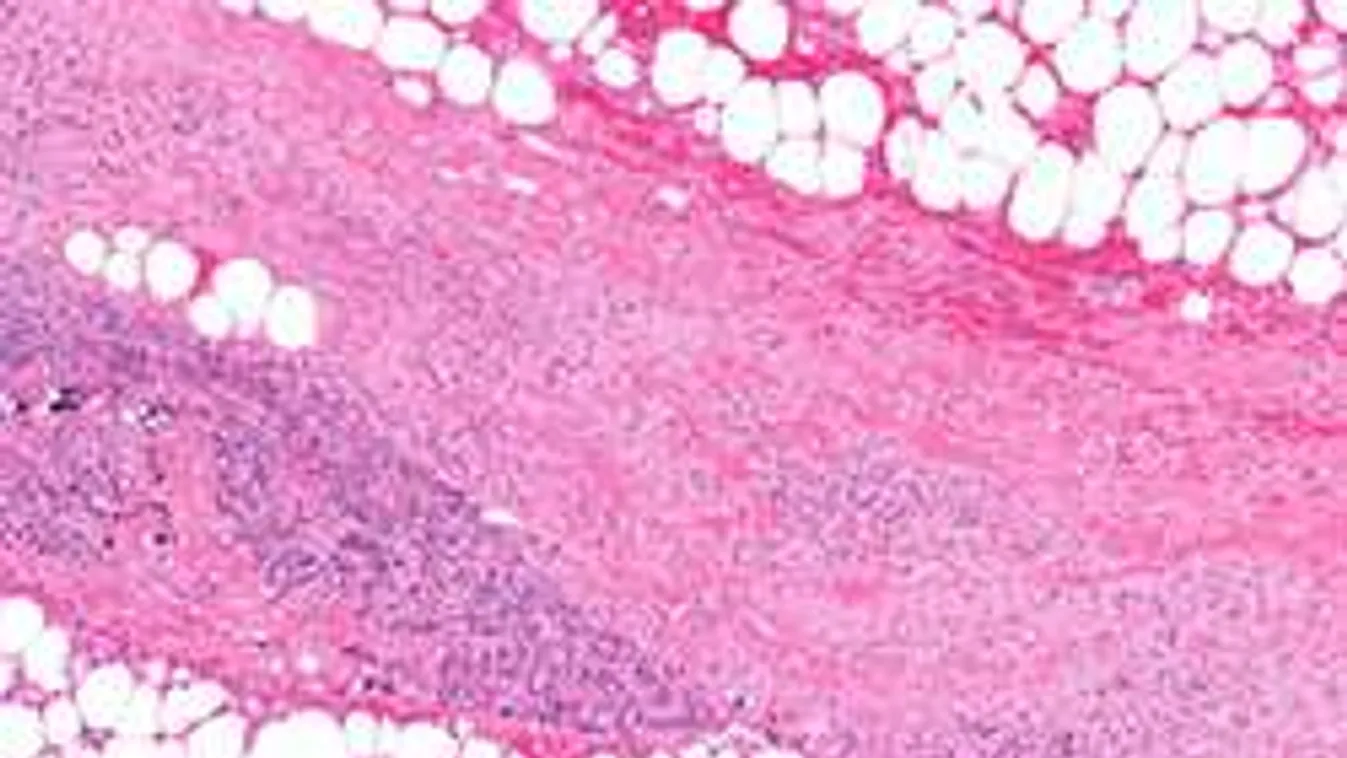 Húsevő baktérium falta fel a férfiasságát