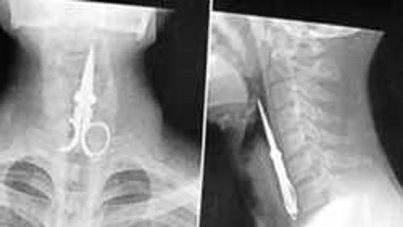 Elképesztő tárgyak az emberi testben: Sokkoló röntgenfelvételek! +18