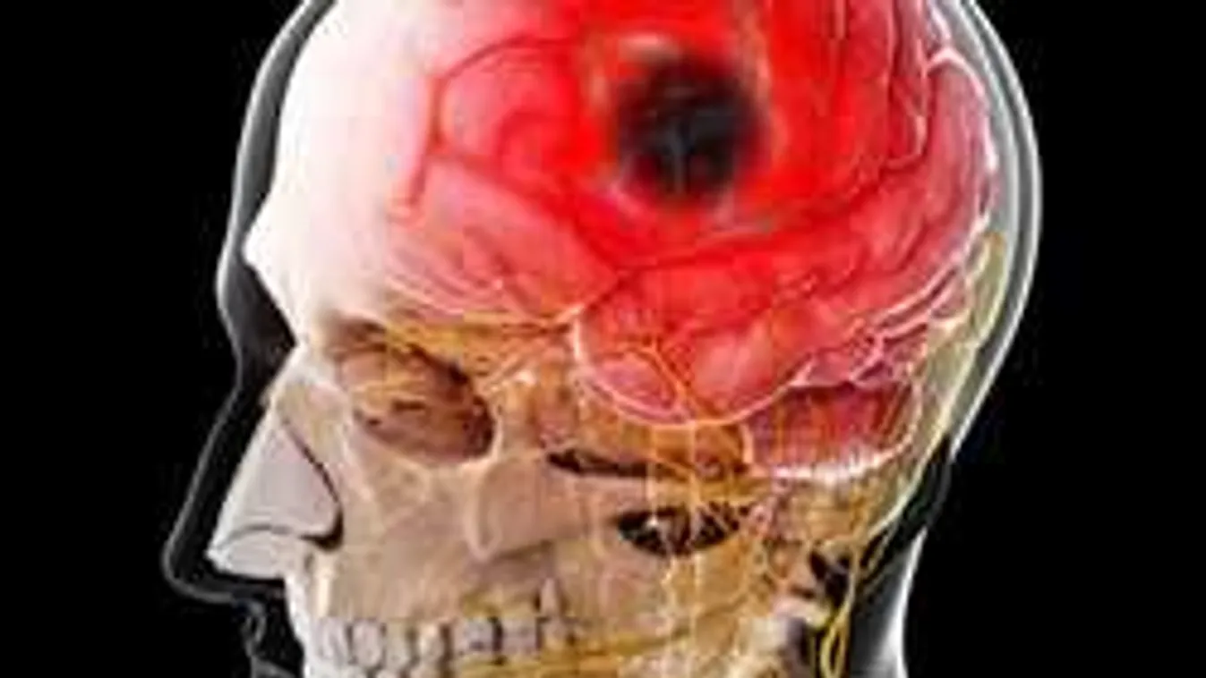 Hatalmas felfedezés, javulhatnak a stroke-on átesett betegek esélyei