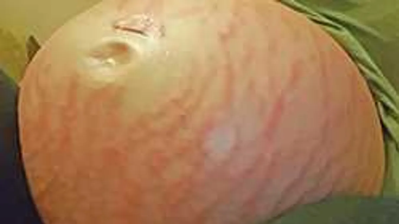 Hihetetlen, de igaz: allergiás volt az anya saját magzatára