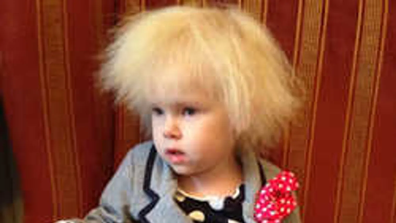 Ritka betegség: Einstein-haja lett a gyereknek