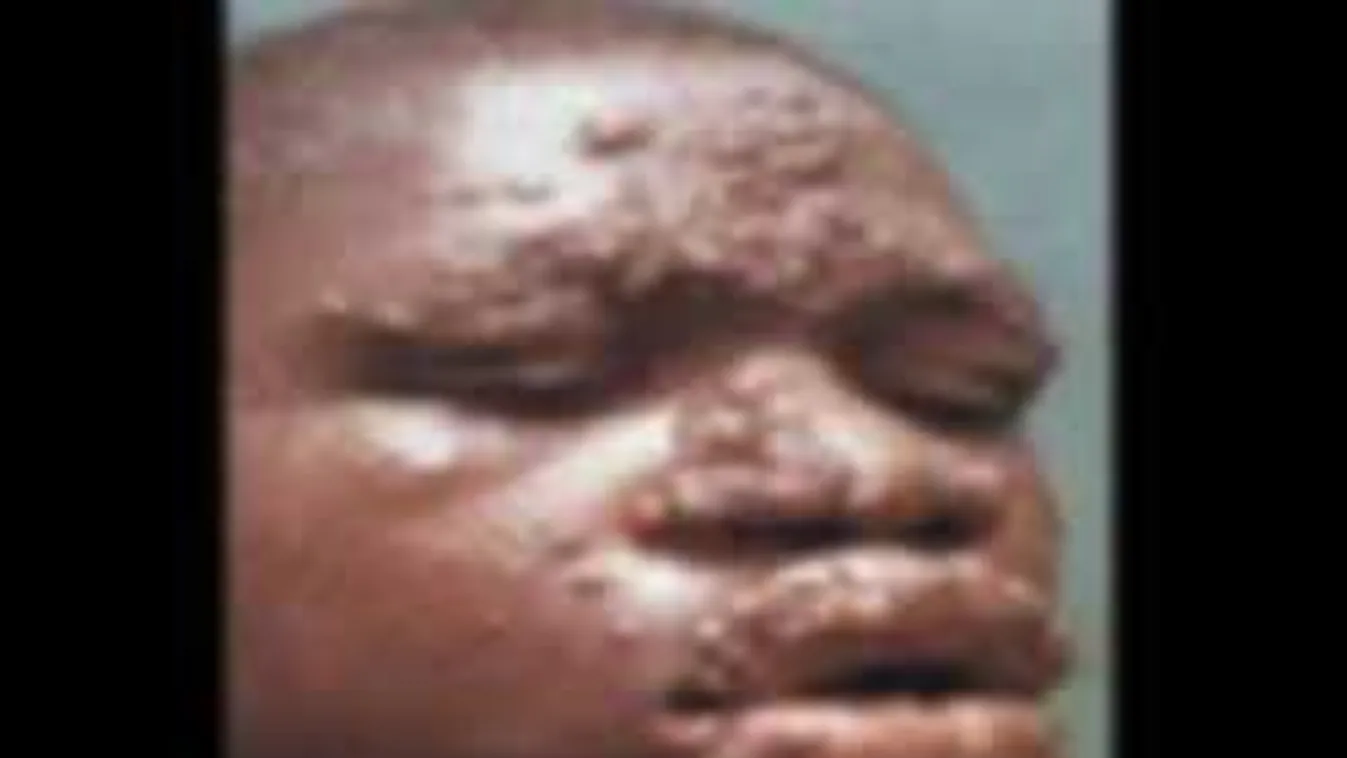 Leprás menekült érkezett Riminibe. Vajon hány embert fertőzött már meg