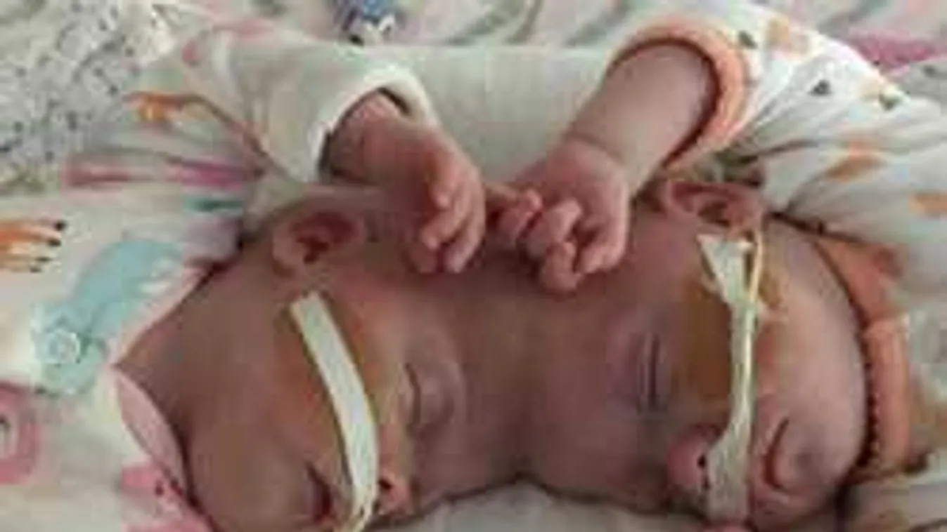 Kettéválasztották a sziámi ikrek agyát