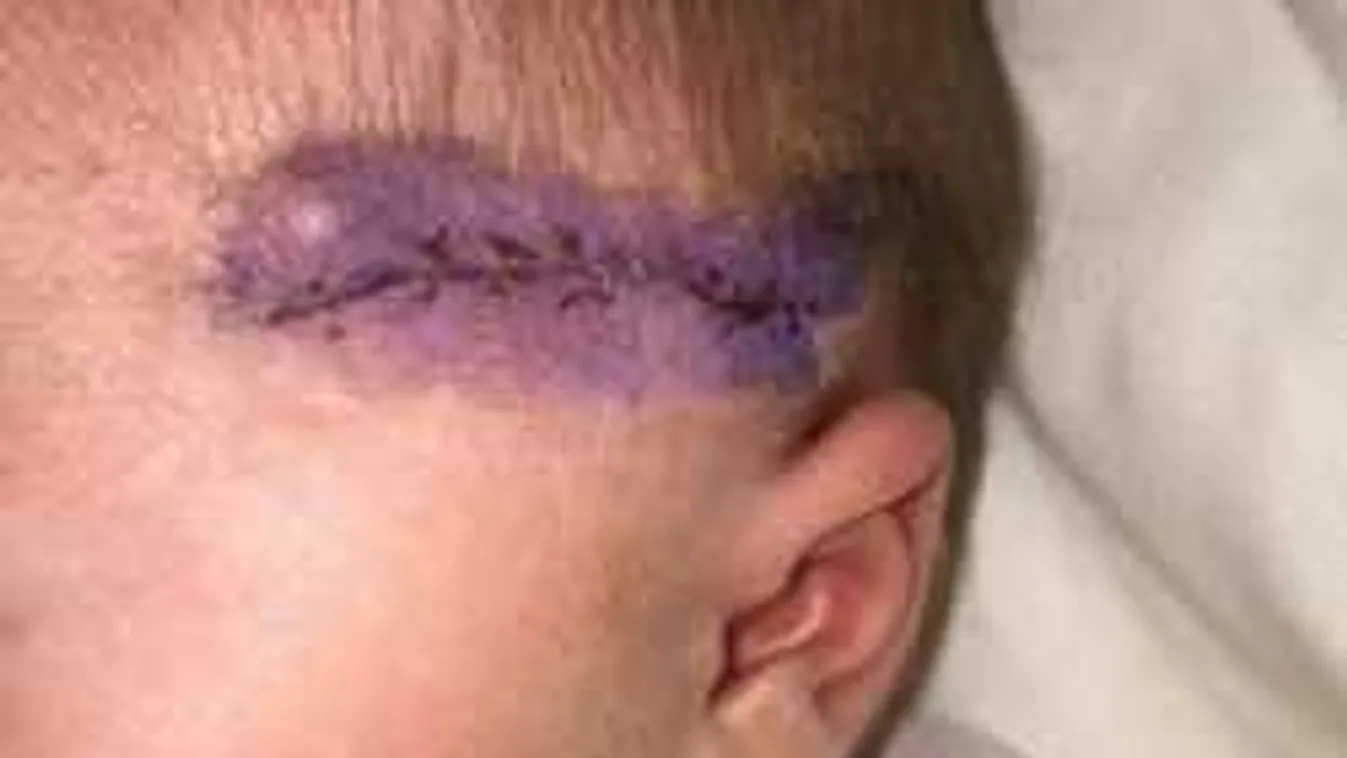 Horror a császármetszésen: végigvágta a baba fejét az orvos