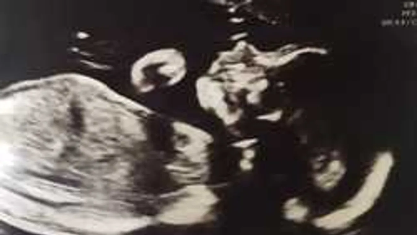 Karácsonyi csodában bízik a halálos agydaganattal kisbabáját váró nő