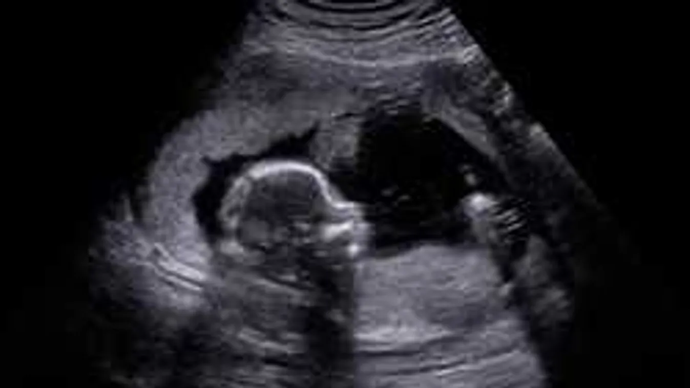Borzalom a szülőszobán: Így jött világra a 15 éves magzat