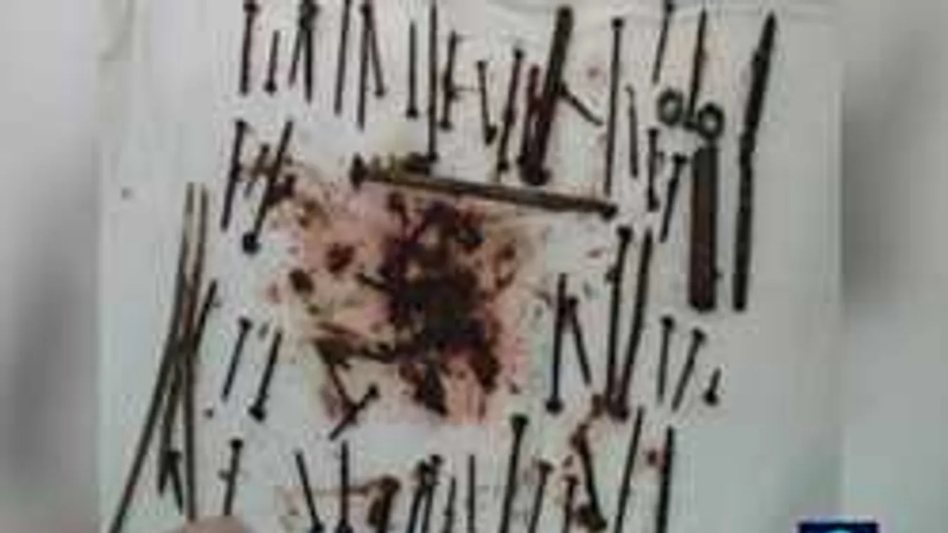 Fájt a hasa a nyugdíjasnak, nagyon durva, mit találtak benne!