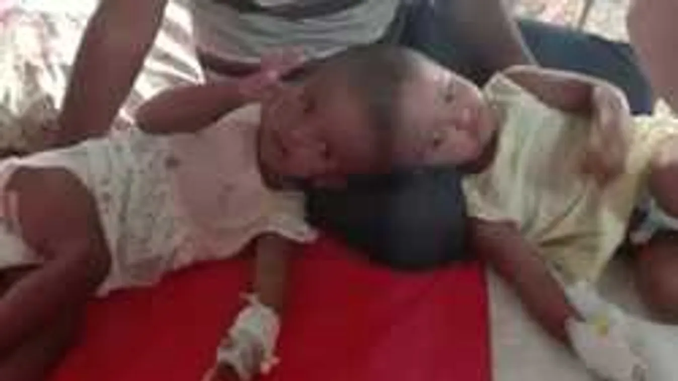 Magyar orvosok választják szét a bangladesi sziámi ikreket