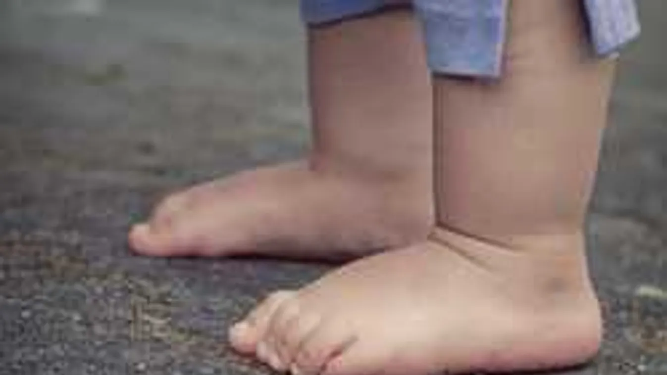 Felfoghatatlan, életveszélyesen megégett a magyar kisbaba apja mellett