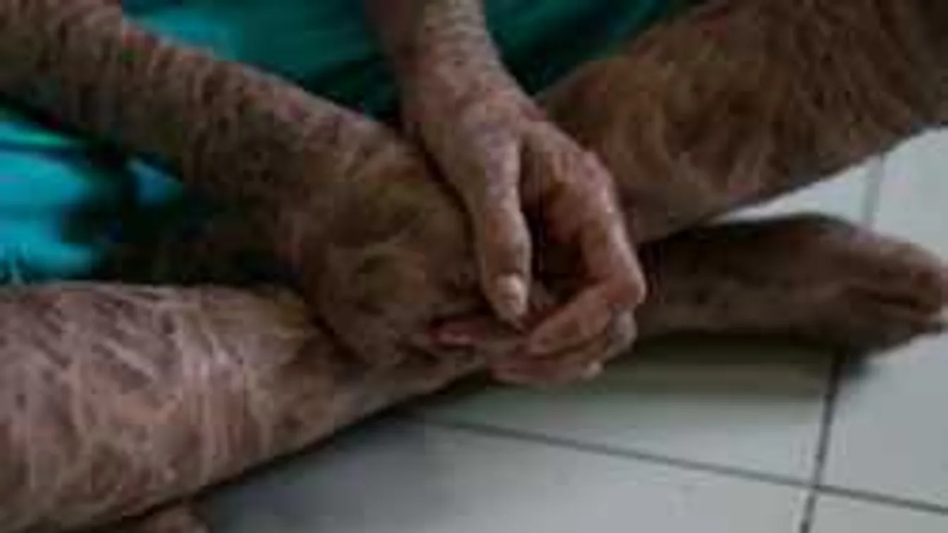 Megrázó fotók, így él a súlyos beteg, 13 éves kígyólány