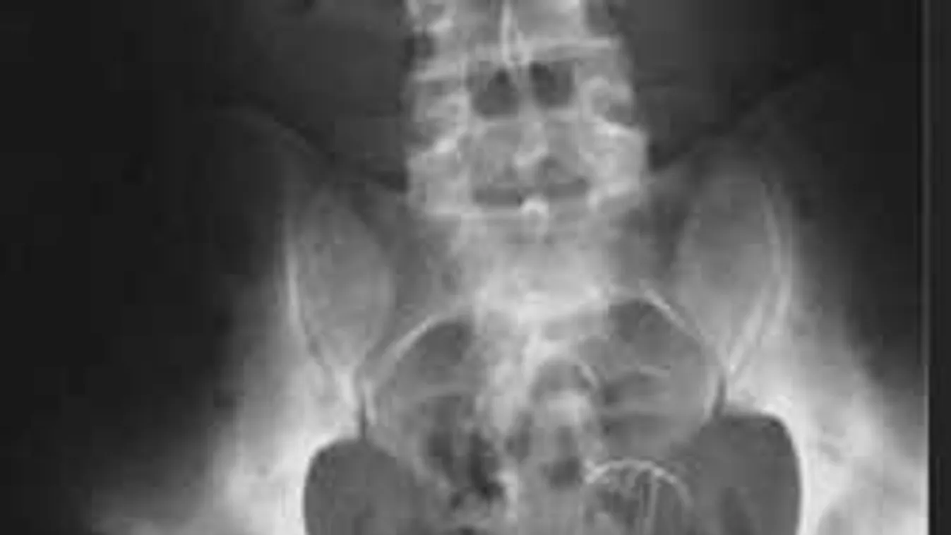 Nagyon durva, miket találnak az orvosok a vaginában: nézd a fotókat...