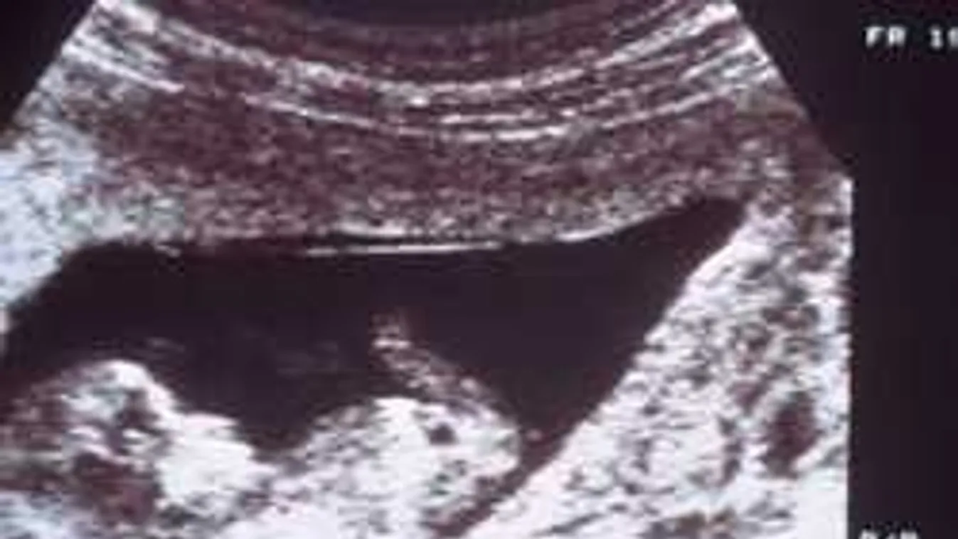 Sokkot kaptak a szülők, amikor meglátták ezt az ultrahangfelvételt