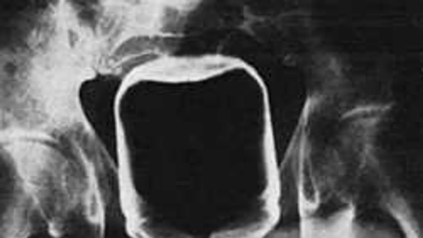 Súlyos röntgenfotók: nem hiszed el, miket találnak emberek fenekében!
