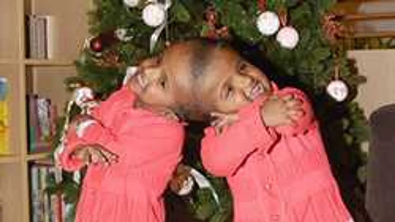 Megműtötték Budapesten a sziámi ikreket!