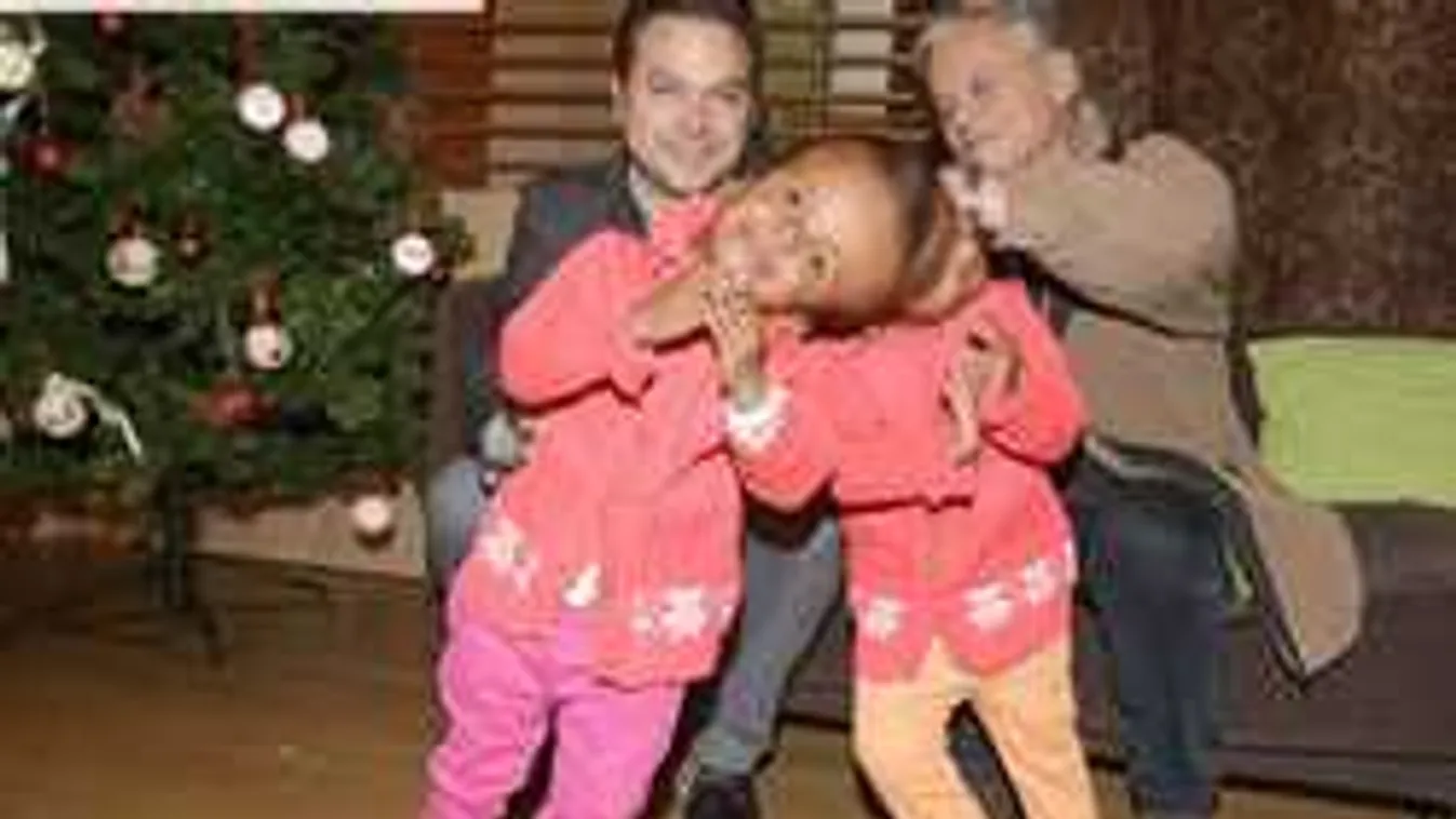 Megkezdődött a visszaszámlálás: 72 órán belül megműthetik a sziámi ikreket Budapesten