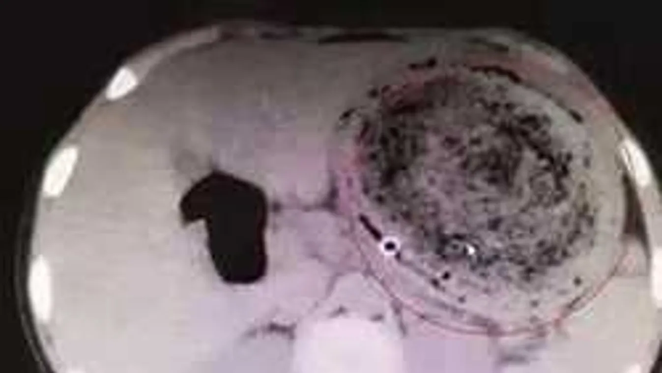 Elsápadt az orvos, amikor meglátta a gyomor CT eredményét