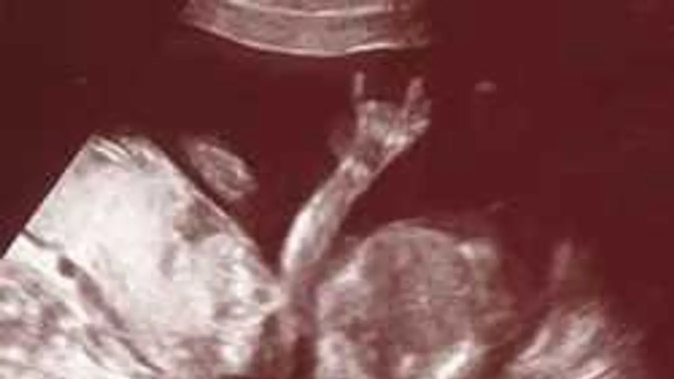 Az orvosok se hittek a szemüknek: ikertestvérével a hasában született