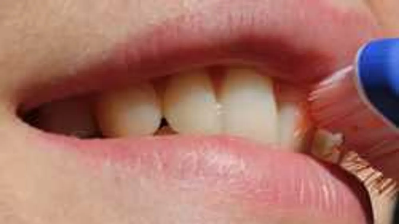 Nagyon durvát állítanak a fogorvosok: halálos betegség múlhat ezen az apróságon