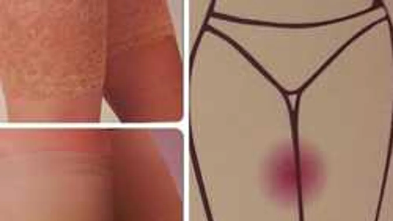 Ezt minden nő utálja nyáron, de itt a megoldás!