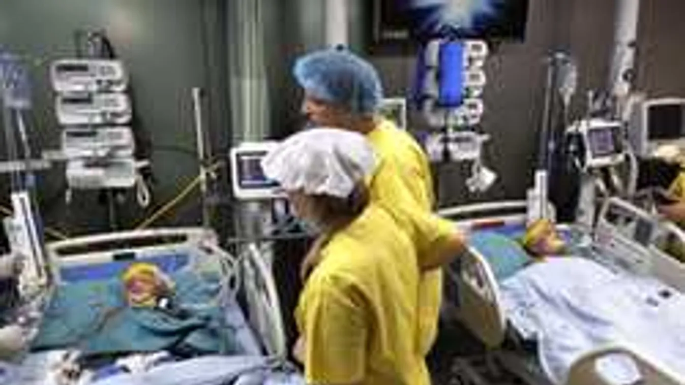 Exkluzív részletek a sziámi ikrek műtétjéről: "Képtelenség volt szétválasztani az agyat"