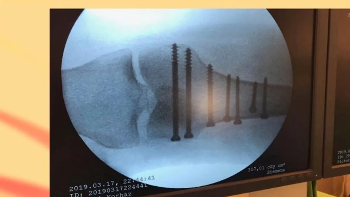 Döbbenetes röntgenfelvételt mutatott csonttöréséről Marsi Anikó