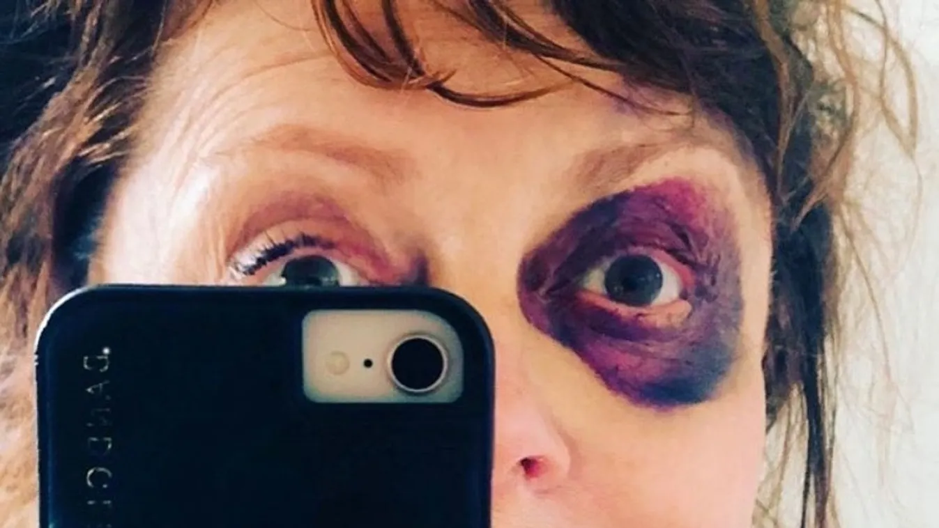 Horrorsérülést szenvedett a 73 éves színésznő, durván néz ki az arca