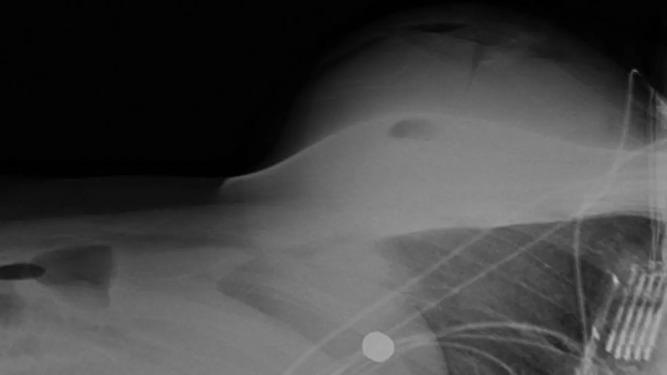 Sokkoló röntgenfelvétel: Hatalmas melle mentette meg a nő életét - Fotó