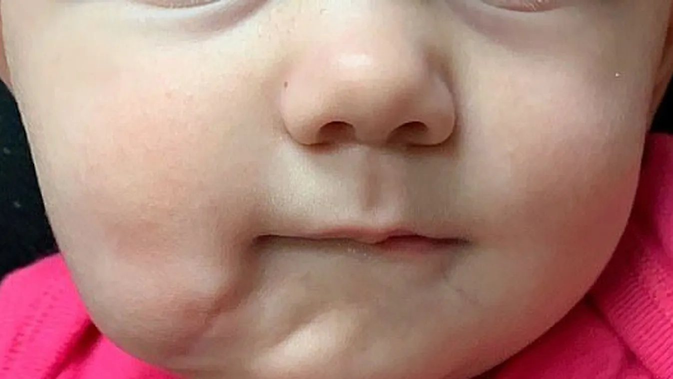 Borzalmas műtéten van túl a kétszájú kislány - Fotó