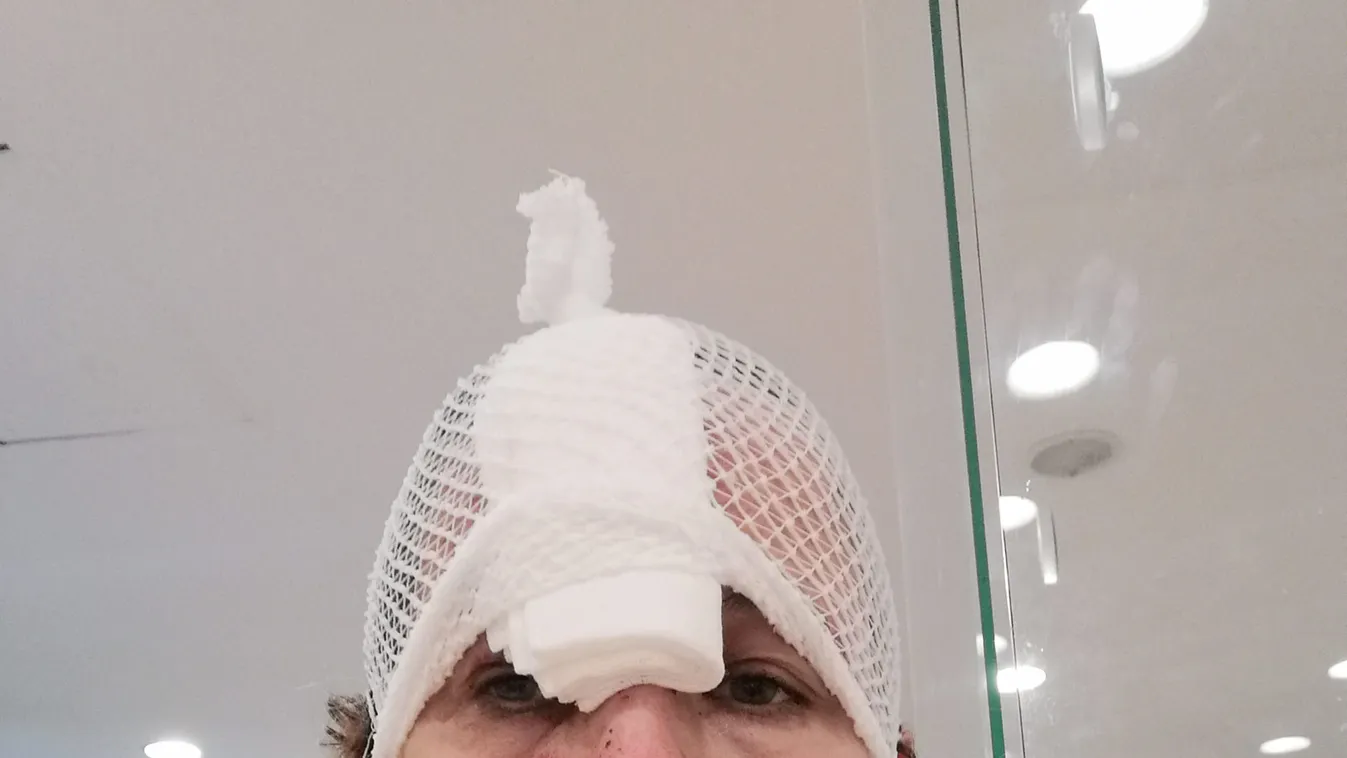 Brutális balesetet szenvedett a 39-es buszon, örökre nyoma marad Anikó arcán