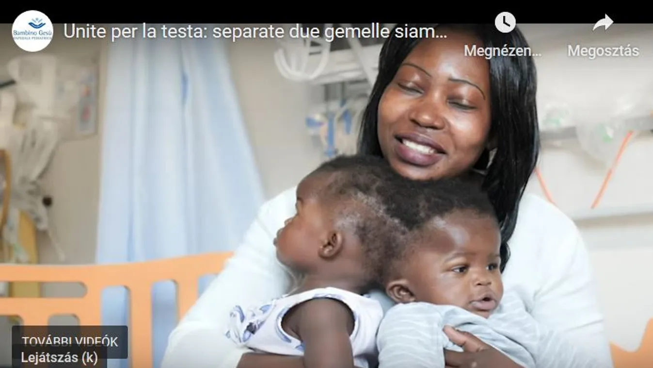 Igazi csoda! Új esélyt kapott a sziámi ikerpár