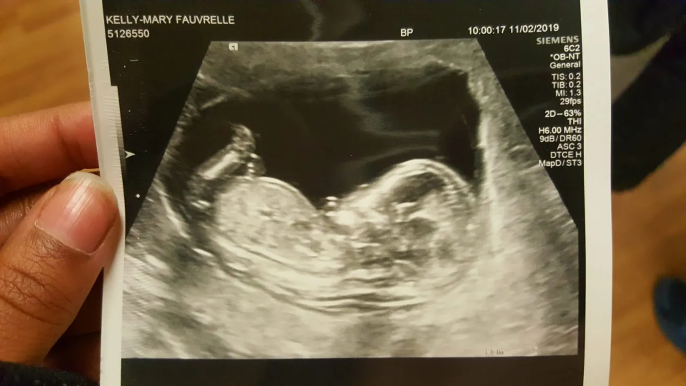 Hidegvérrel, 21 késszúrással megölte terhes barátnőjét: a baba életét sem tudták megmenteni