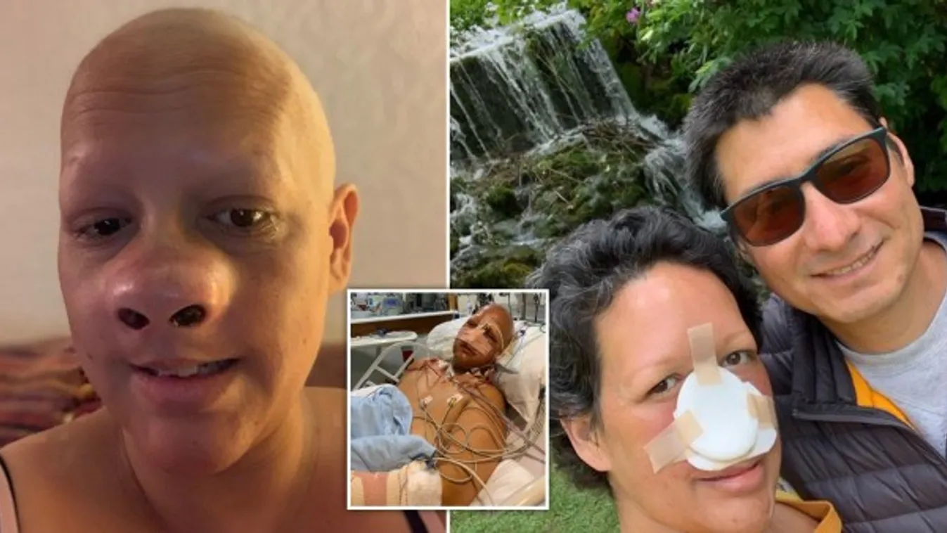 "A világom kifordult önmagából" - az egész orrát el kellett távolítani az édesanyának - sokkoló fotó