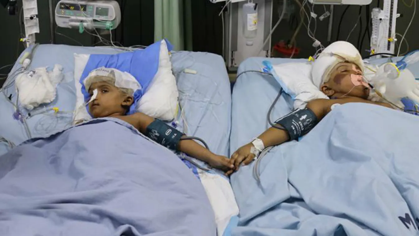 Exkluzív dokumentumfilm! Így kerültek a bangladesi sziámi ikrek a magyar orvosokhoz