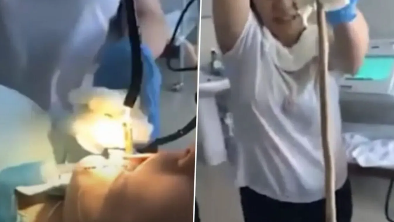 Sokkot kaptak az orvosok, 1 méter hosszú kígyót távolítottak el egy nő torkából – videó!