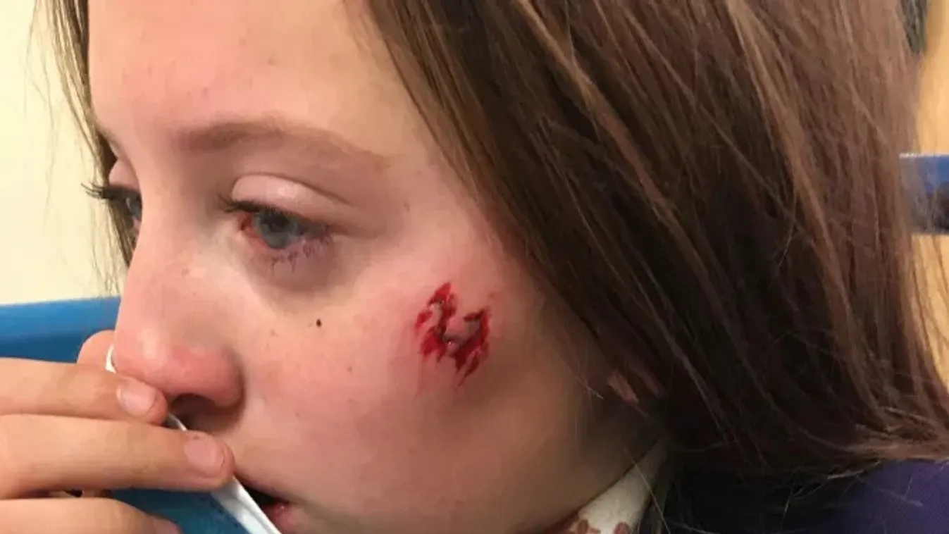 "Élete végéig viselni fogja a heget" - arcon harapott egy 11 éves lányt egy veszett kutya