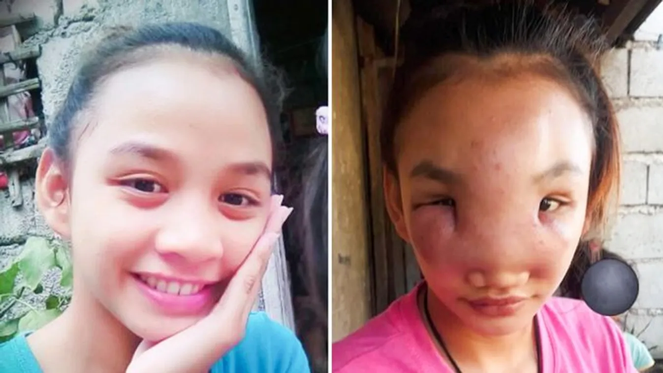 Megvakult a 17 éves lány, miután megnyomott egy pattanásnak hitt foltot az orrán