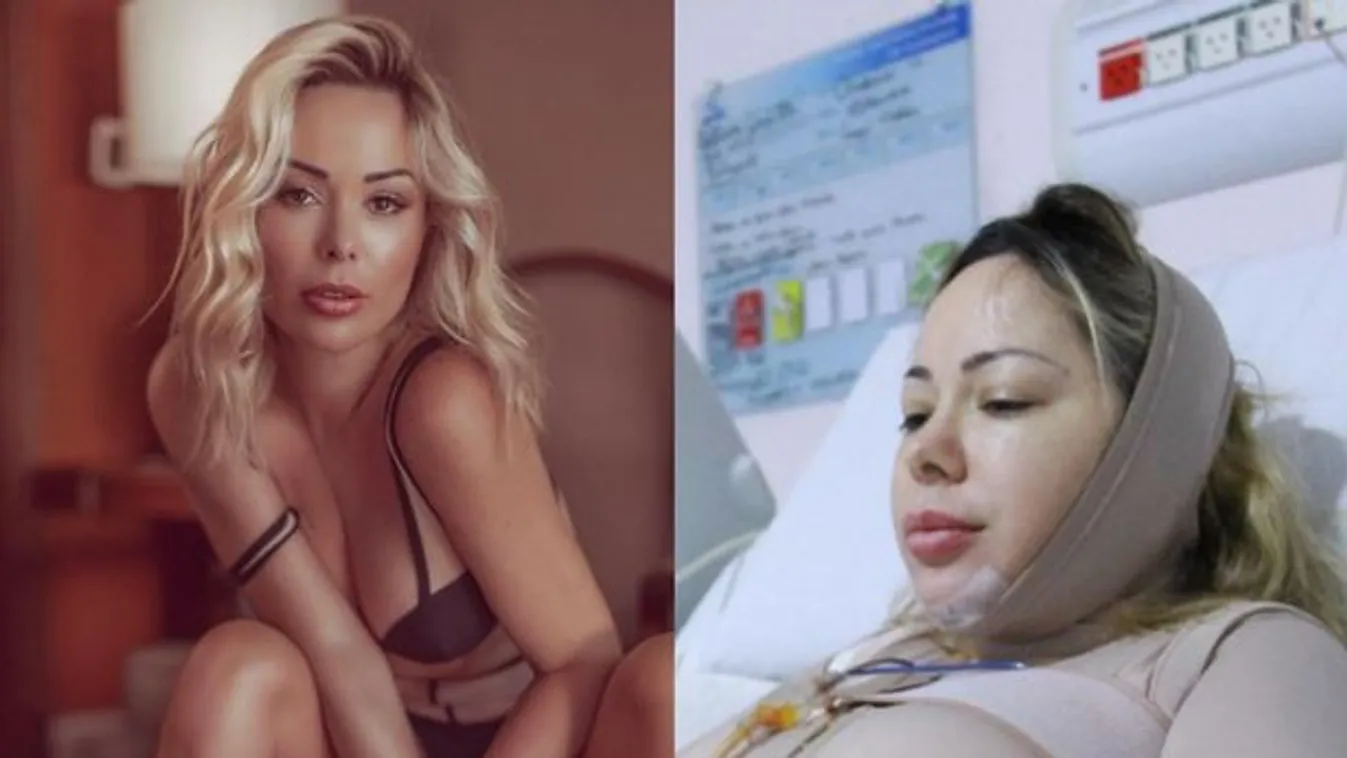 Te jó ég: Felismerhetetlenné szabattá magát a plasztikafüggő modell - Fotó