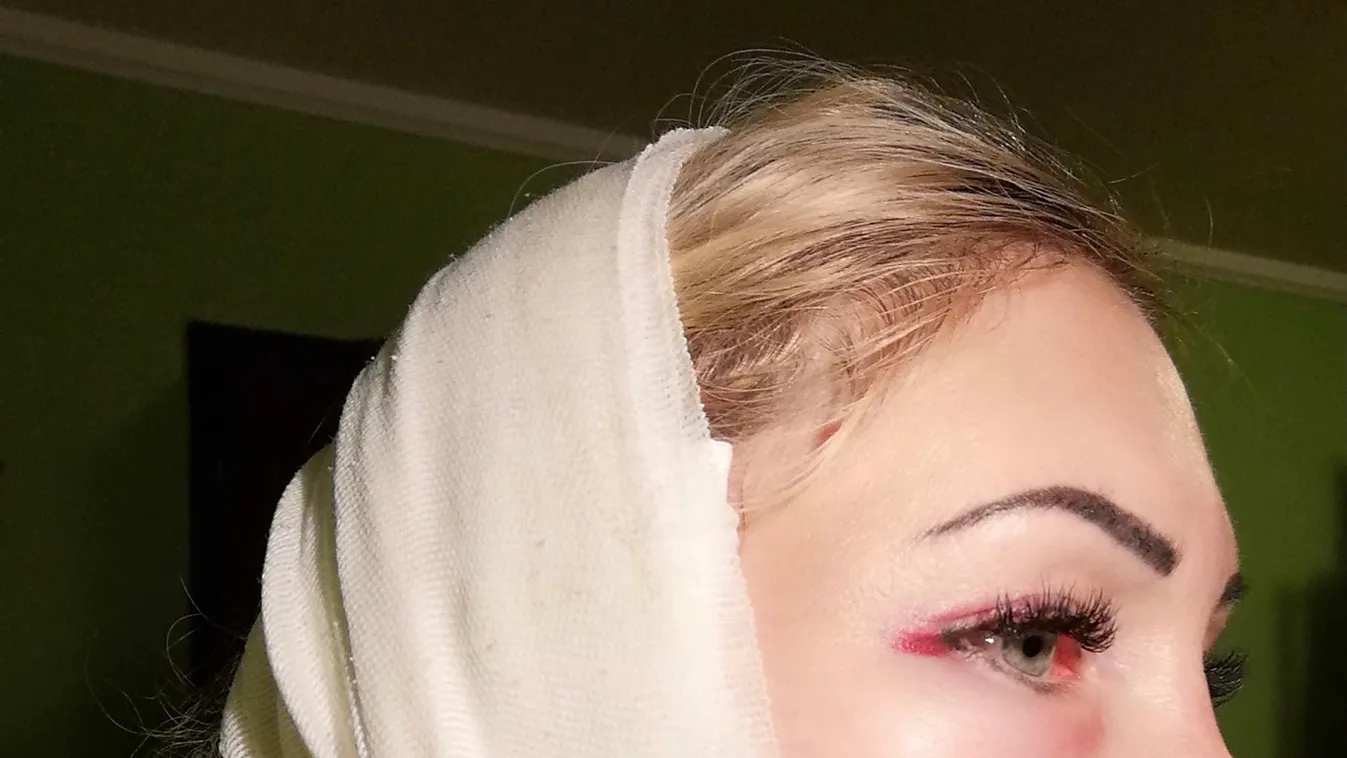 14 hónap után is műteni kellett a brutálisan összevert Bernit