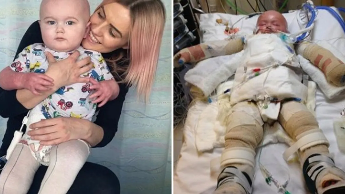 Sokkot kaptak a szülők: lejött az egészséges gyermekük bőre, 50 műtéten van túl